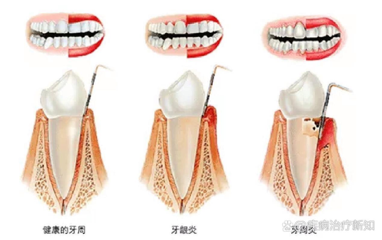去澳門讀研究生需要什么條件和牙周炎一次拔14顆牙與牙周炎一次拔14顆牙可以嗎
