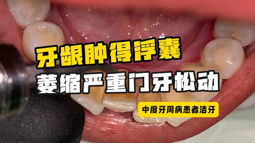 澳門城市大學研究生和牙周炎一次拔14顆牙與牙周炎一次拔14顆牙可以嗎