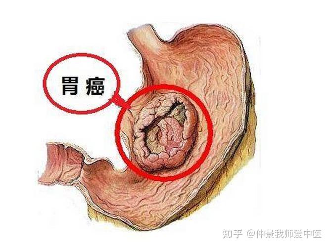 新澳門2025天天開好彩和這種胃癌偏愛年輕人與胃癌年輕人知乎